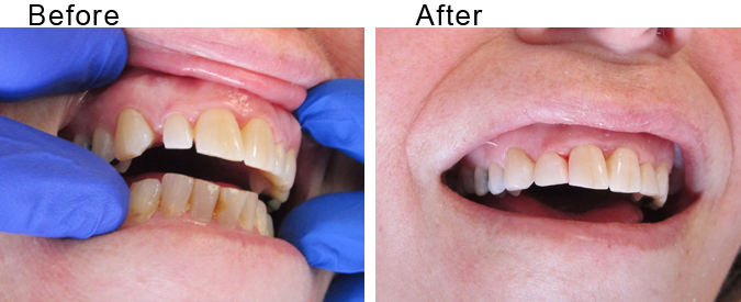 Invisalign beforea and after by Divine Dental Center in Yorkton, SK