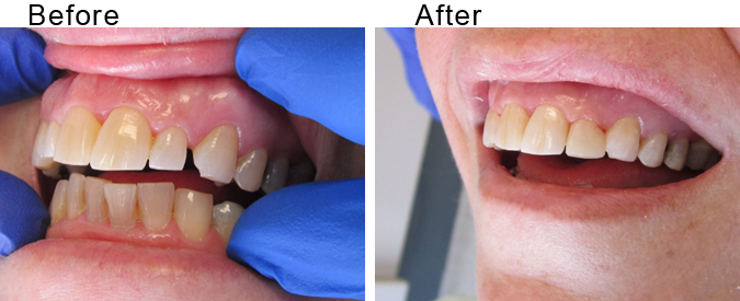 Bridge veneer before and after by Divine Dental Center in Yorkton, SK