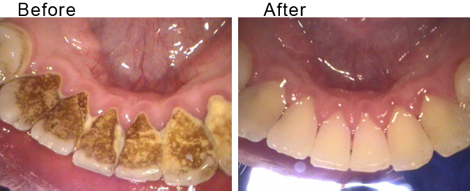 Teeth bleaching before and after by Divine Dental Center in Yorkton, SK