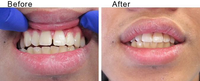 Tooth implant before and after by Divine Dental Center in Yorkton, SK