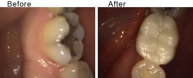 Root canal before and after by Divine Dental Center in Yorkton, SK
